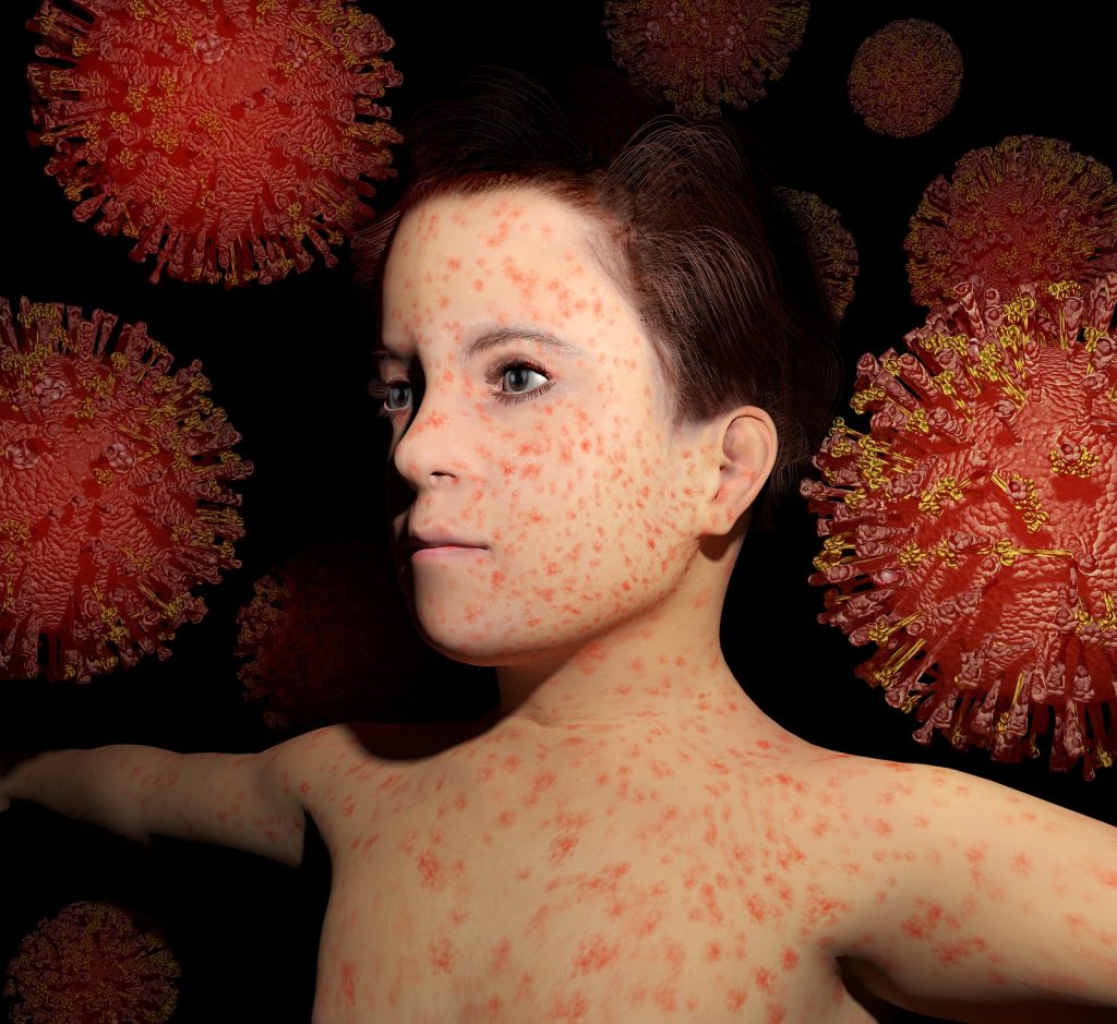 The Story of Measles’ Sharp Decline