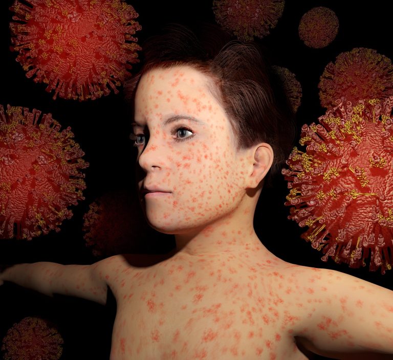 image of boy with measles