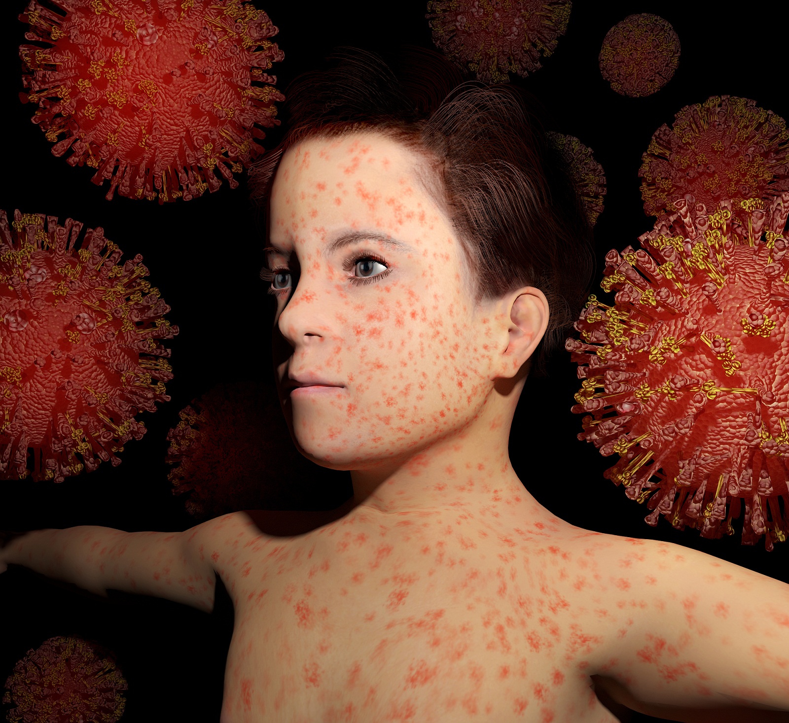 image of boy with measles
