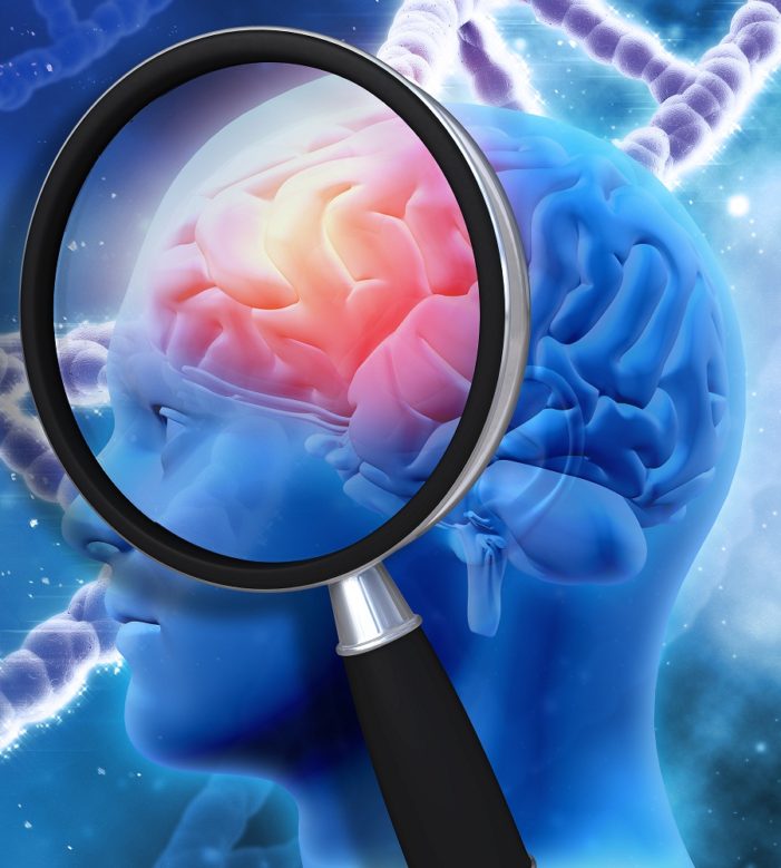 inflamed brain Chronic Inflammation in Alzheimer’s Disease