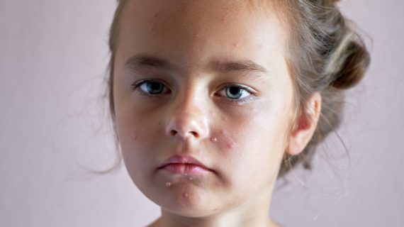 girl with chickenpox CDC Accused of Manipulating Shingles Data