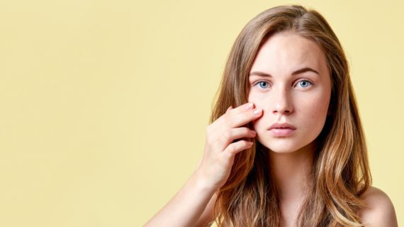 girl with acne Vaccine for Acne Targets Bacteria in the Skin’s Microbiome