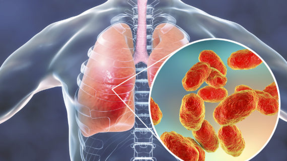 Hib in lungs Has the Hib Vaccine Simply Shifted the Risk Burden to the Elderly?