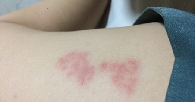 shingles Herpes Zoster May Be a Risk of COVID-19 Vaccination for Immunocompromised