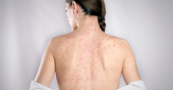 Shingles May Be Triggered by COVID Shots