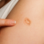 smallpox vaccine scar