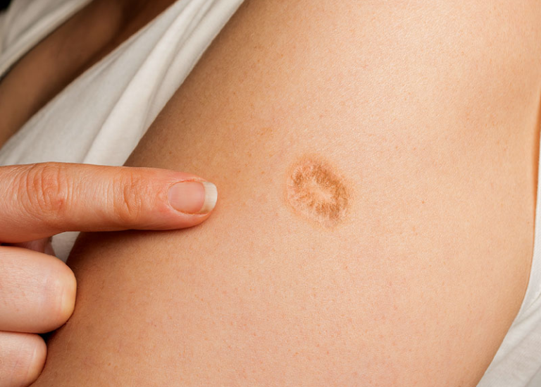 smallpox vaccine scar