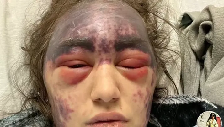 Young Woman With Blood Disorder Develops Painful Severe Reaction to Multiple Vaccinations