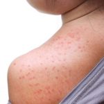 Measles Outbreak in Texas